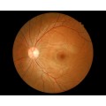 3D Non-Mydriatic Retinal Camera